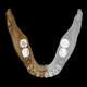 Virtual reconstruction of the mandible, with extrapolated segment shown in grey.